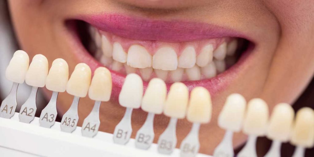 07 Benefícios de se colocar facetas em resina nos dentes